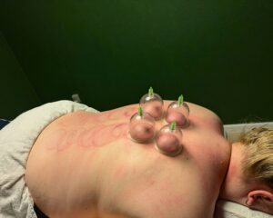Sådan kan en cupping behandling s ud